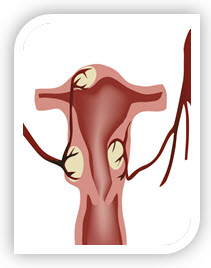 Package for Fibroid Uterus(Garbhasayarbuda) by Baba Ramdev